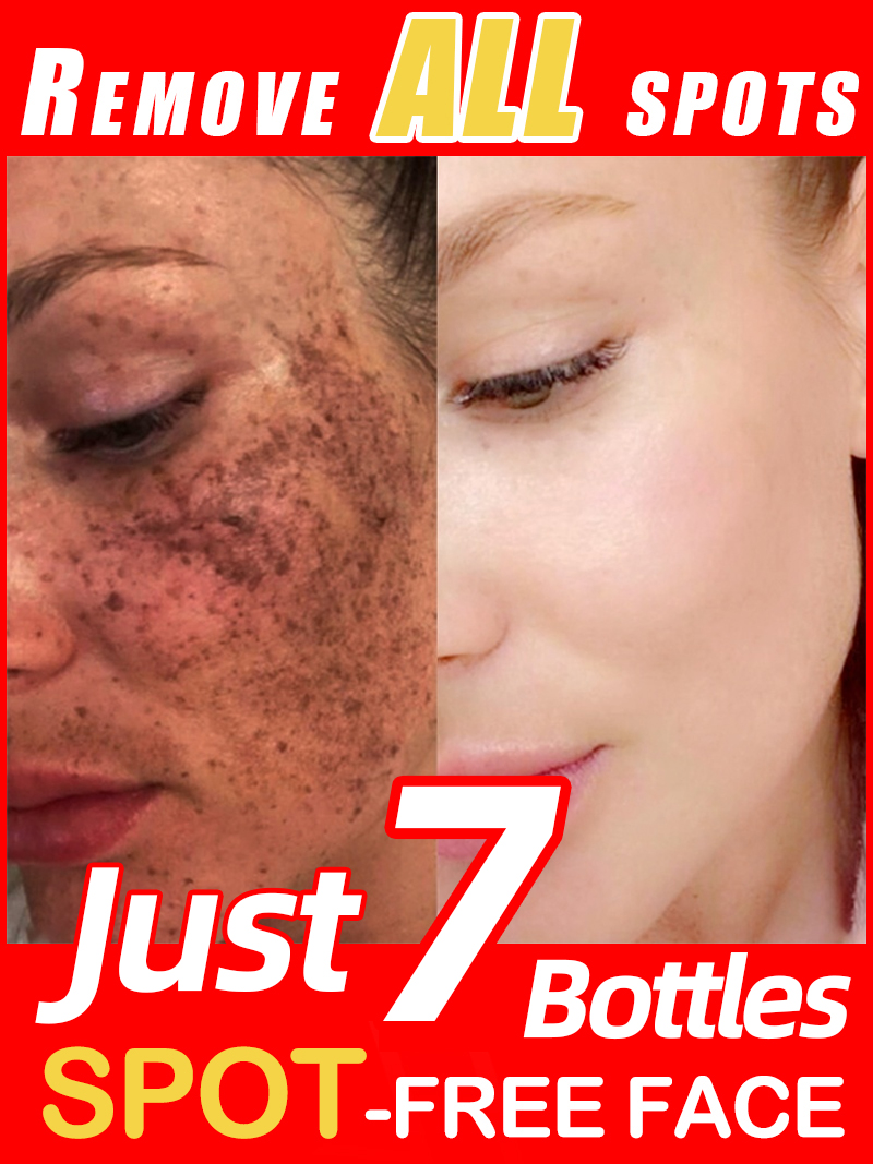Ilumina las pecas Melasma, las - Skincare Luxury Whitening reseña y precio
